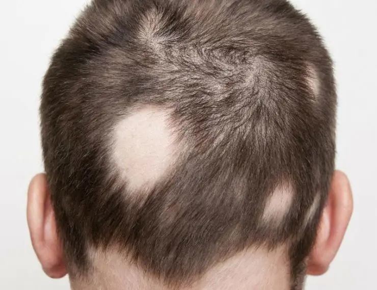 Saçkıran (Alopesi areata)